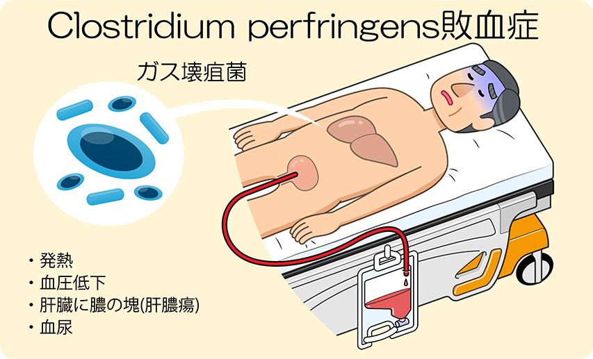 ガス壊疽 血清療法